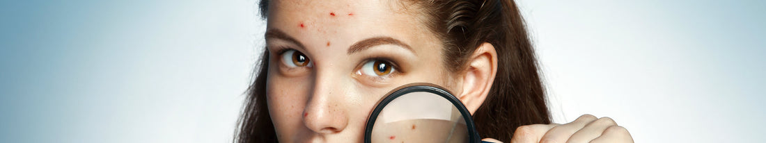 5 Best Methods To Shrink The Appearance Of Pimples And Acne