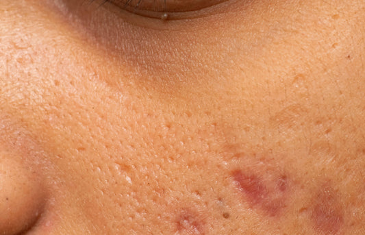 Can You Really Shrink Your Pores?